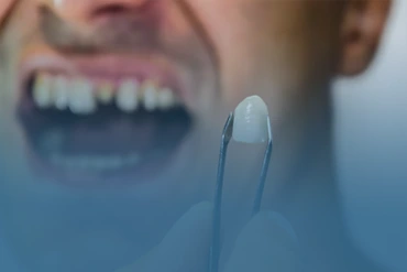 Cerec Crowns