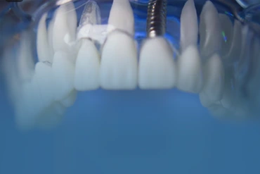 detal-implants